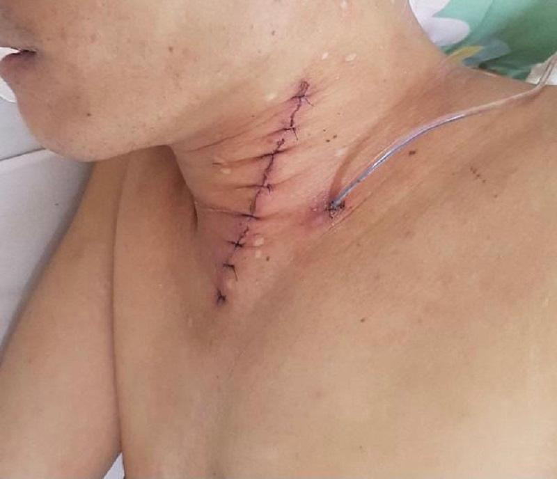 Ca mổ lấy dị vật cho bệnh nhân N.V.L. tại Bệnh viện Việt Đức