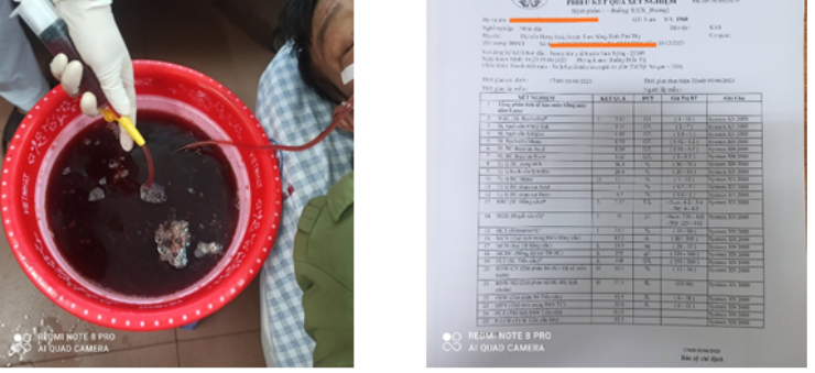 Máu đỏ chảy ra từ sonde dạ dày người bệnh khi được xử trí cấp cứu