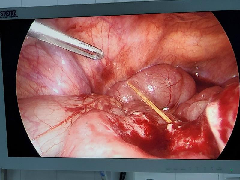 Hình ảnh dị vật là chiếc tăm nhọn đâm thủng ruột bệnh nhân