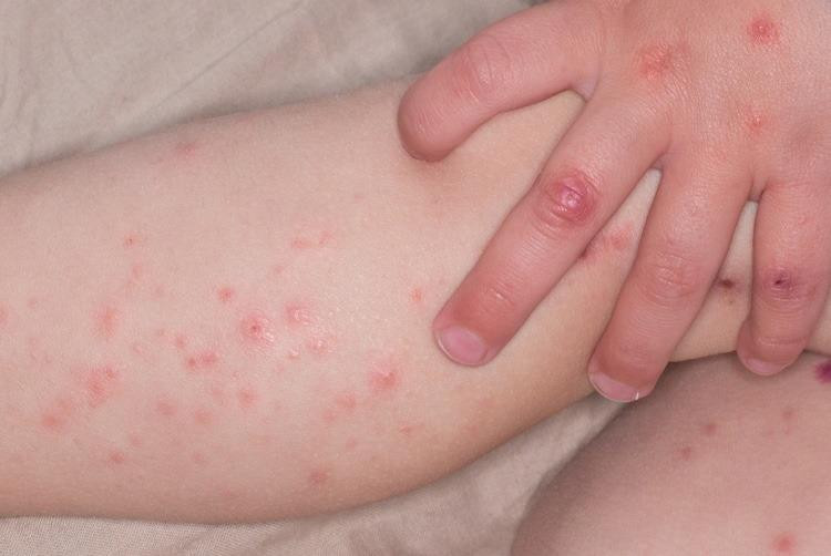 Số trẻ mắc tay chân miệng tăng vọt ở Hà Nội