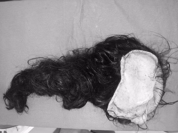 Cháu bé nhập viện trong tình trạng phần da đầu bị lột hoàn toàn