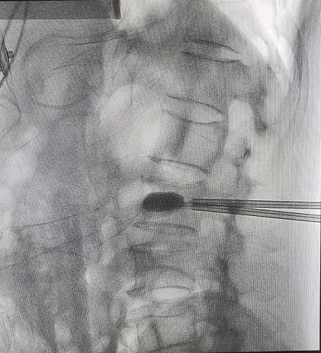 Các bác sĩ thực hiện bơm xi măng trên máy DSA