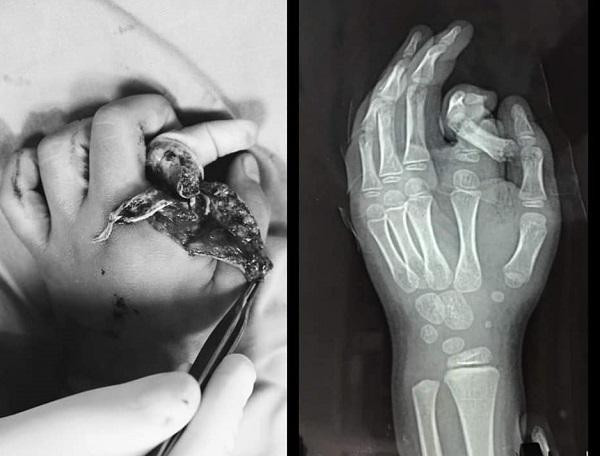 Hình ảnh ngón tay của cháu bé bị cụt khi nhập viện Hình ảnh ngón tay của cháu bé bị cụt khi nhập viện