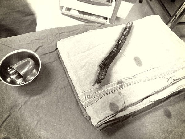 Dị vật là thanh gỗ xuyên thấu vùng mũi - mặt của bệnh nhân được bác sĩ lấy ra