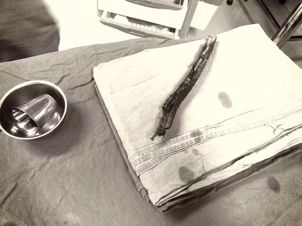 Dị vật là thanh gỗ xuyên thấu vùng mũi - mặt của bệnh nhân được bác sĩ lấy ra