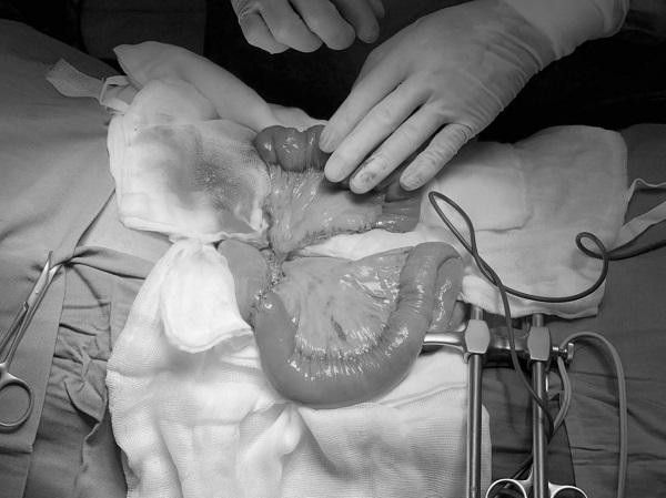 Các bác sĩ thực hiện ca ghép nối ruột tái tạo đường ăn cho bệnh nhân ung thư