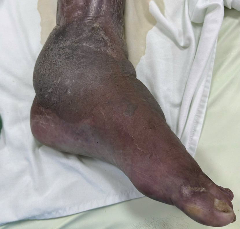 Vùng cẳng chân người bệnh sưng phồng