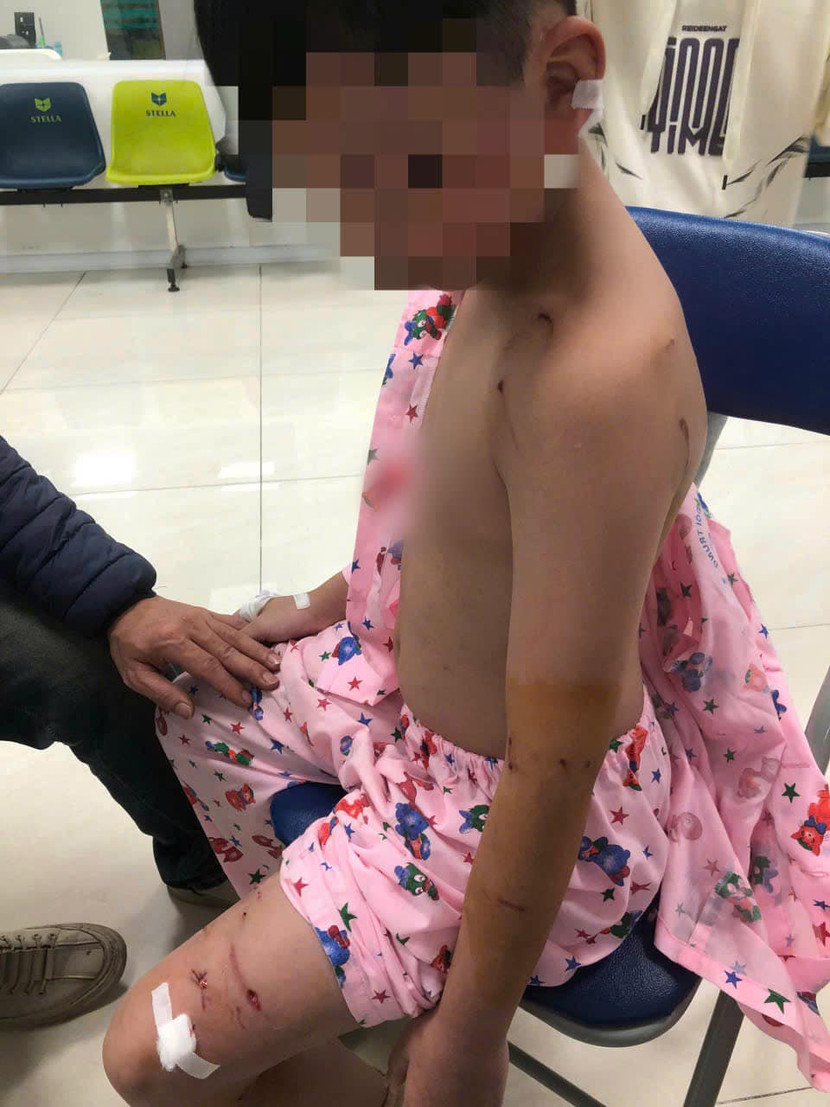 Cháu bé được xử lý điều trị tại Bệnh viện Bệnh Nhiệt đới Trung ương