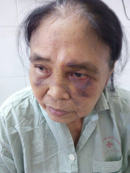Mâu thuẫn với chồng, vợ dẫn người đánh mẹ chồng chấn thương sọ não ảnh 1
