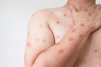 Những đáng ngại về dịch bệnh đậu mùa khỉ đang lây lan mạnh ở châu Phi