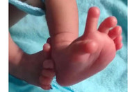 Trẻ sơ sinh có 26 ngón tay chân được tin là hiện thân của nữ thần Ấn Độ