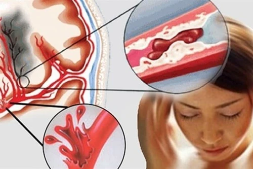 Thói quen phổ biến vào mùa lạnh làm tăng nguy cơ đột tử 