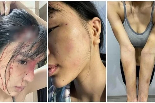 Cơ quan điều tra nói gì về vụ siêu mẫu Khả Trang tố bị bạo lực ?