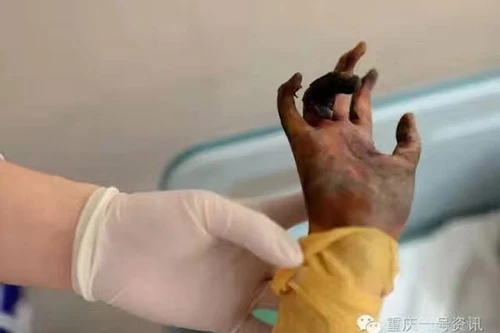 Bé gái bỏng 80% cơ thể vì cứu bố