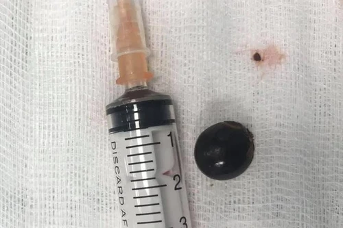 Cứu sống bé 12 tuổi bị hóc hạt nhãn