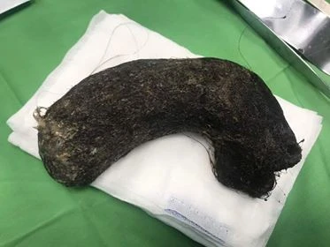 Hi hữu: Phẫu thuật lấy búi tóc nặng 1kg trong dạ dày bé gái 11 tuổi