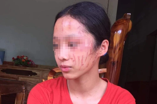 Bênh em gái, nữ sinh cào rách mặt bạn học