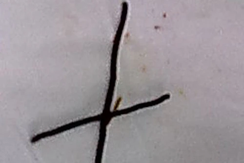 Nuốt hai sợi dây kẽm vì giận người thân