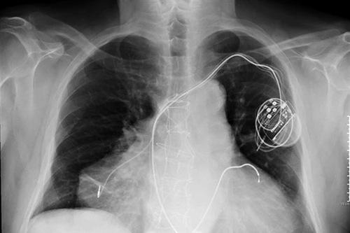 Người sống cùng 2 trái tim