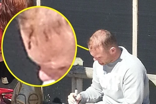 Cận cảnh vết thương kinh hoàng của Rooney