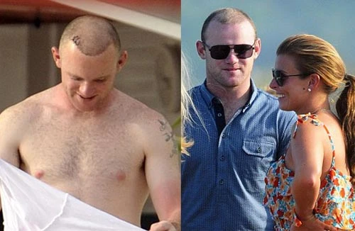 Thuốc mọc tóc khiến Rooney tăng ham muốn tình dục?