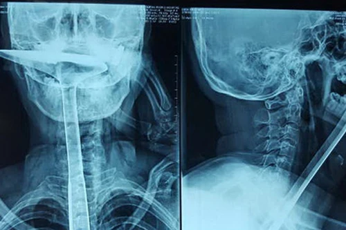 Dại dột dùng xẻng nấu ăn thông họng