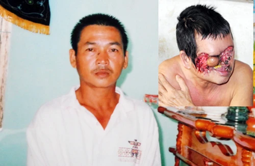 Biến dạng mặt vì… tẩy nốt ruồi