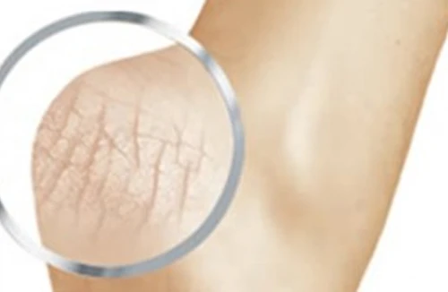 Xử lý nứt gót chân