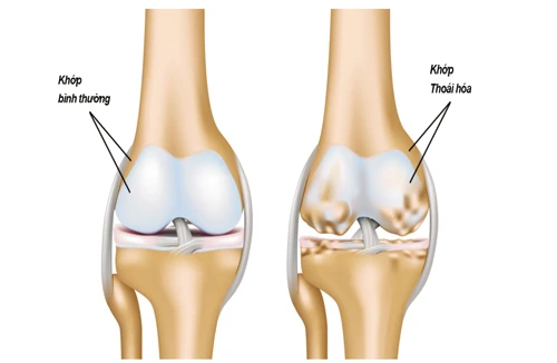 Những điều cần biết về cách chữa trị bệnh thoái hóa khớp