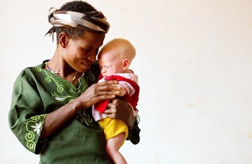 Người bạch tạng sống trong hãi hùng