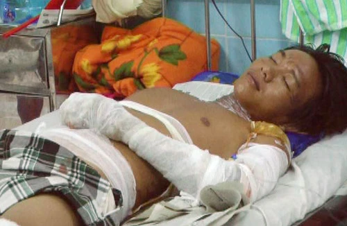 Nổ bồn xăng, 2 người bị thương nặng