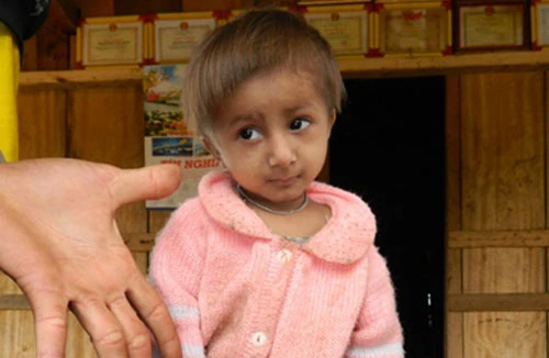 Chú bé “tí hon” 5 tuổi chỉ cao gần 50cm