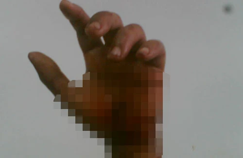 Kịp ngâm đá lạnh, cánh tay đứt lìa được ráp nối