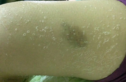 Tắm trắng tại nhà, cô gái bị "lột da" loang lổ toàn thân