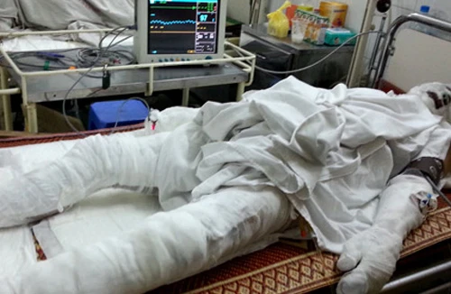 Hai nạn nhân bị điện giật khi đào đường đã qua cơn nguy kịch