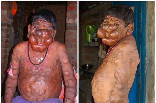Cậu bé Ấn Độ khốn khổ vì bị hàng trăm khối u nổi trên cơ thể