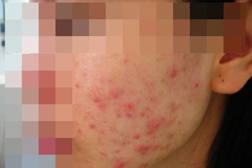 Chất bảo quản: "Sát thủ giấu mặt" trong những sản phẩm làm đẹp