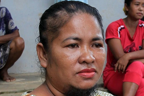 Người phụ nữ mọc râu và lông ngực bất thường như đàn ông