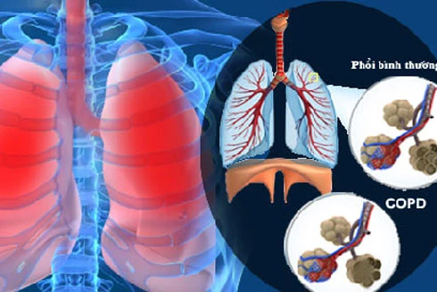 Những bệnh lý nguy hại về phổi