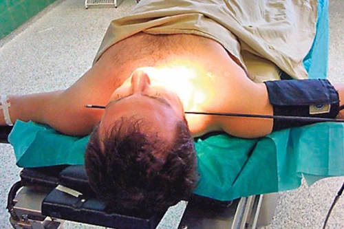 Bị tên bắn xuyên cổ không chết