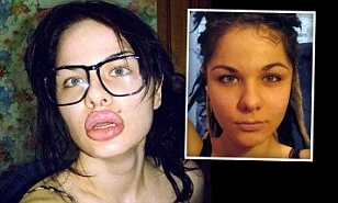 Kinh hoàng đôi môi sưng vù sau 100 lần tiêm