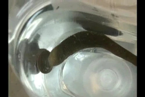 Khiếp vía nhìn đỉa dài 10 cm sống trong cổ họng suốt 2 tháng