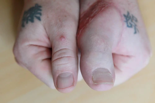 Người đàn ông có ngón chân cái trên bàn tay