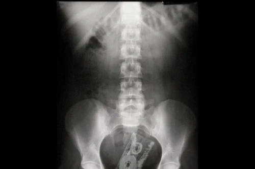 Bộ sưu tập ảnh các "vật thể lạ" trong bụng