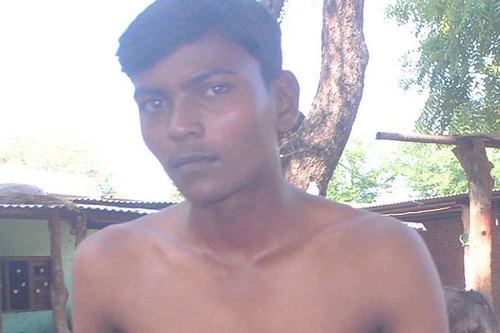 18 năm sống với quả tim ngoài lồng ngực