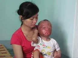 Thảm thương cháu bé bị cha tẩm xăng đốt 