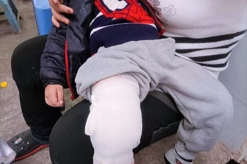 Dừng hoạt động cơ sở mầm non có trẻ 3 tuổi bị gãy chân