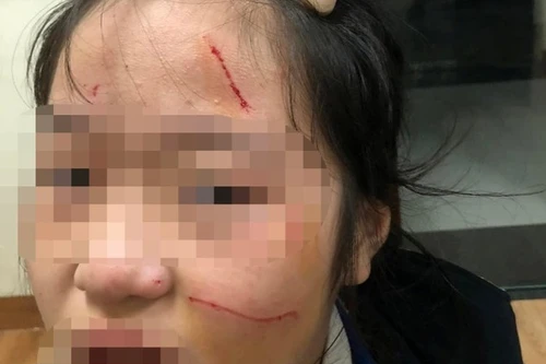 Xử lý kỷ luật học sinh đánh bạn chảy máu, rách mặt ở Hà Đông