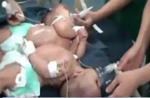 Tách thành công cặp song sinh dính liền bụng