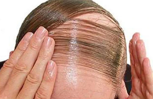 Trị liệu mới cho bệnh hói đầu và bạc tóc